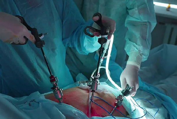 Laproscopic Gall Bladder Surgery